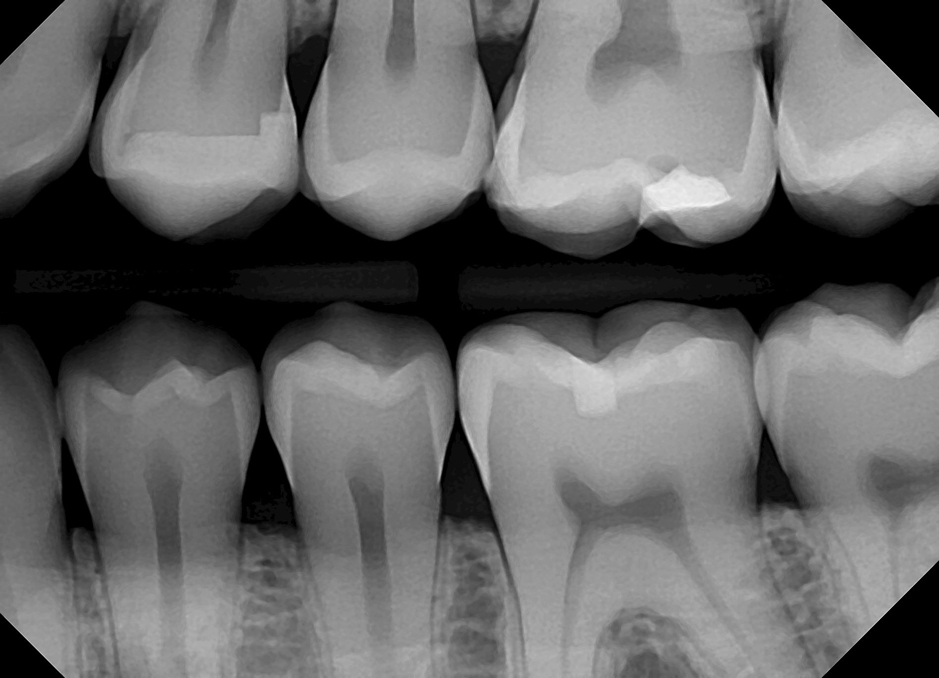 Bitewing Xrays