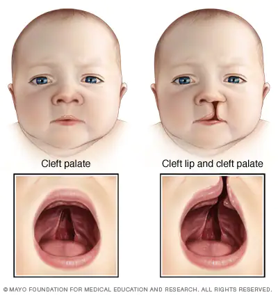 Cleft-Palate