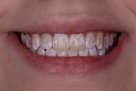 Dental-Fluorosis