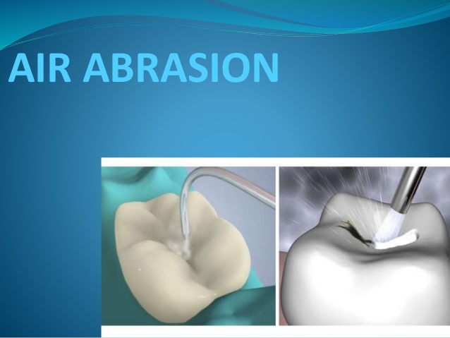 air-abrasion-technology-in-conservative-dentistry-15-638