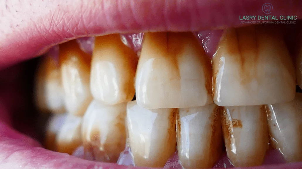 Tooth-Discoloration