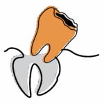 Illustration of a tooth being pushed out of the gum