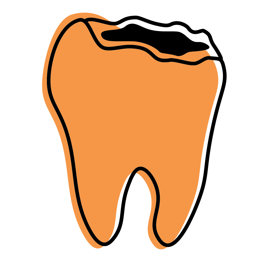 Illustration of a tooth with a large visible crack