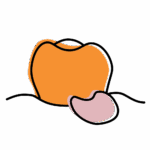 Illustration of a tooth with gum swelling, showing an abscess