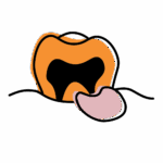 Illustration of a tooth with black cavity and gum swelling, showing abscess