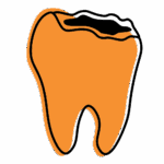 Illustration of a tooth with deep crack on top surface, symbolizing fracture