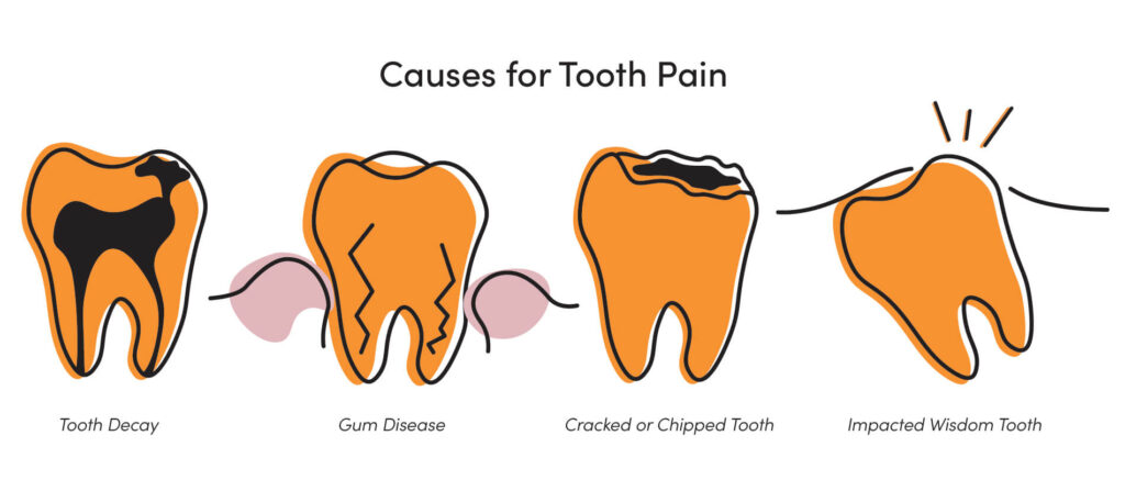 Illustration of tooth pain causes: tooth decay, gum disease, cracked tooth, and impacted wisdom tooth