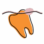 Illustration of a tooth partly covered by gum tissue with swelling, symbolizing pericoronitis