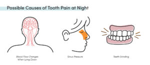 Causes of tooth pain: blood flow when lying down, sinus pressure in cheeks/forehead, and teeth grinding
