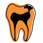 Illustration of a severely decayed tooth with large black cavity covering most of the surface