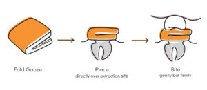 Step-by-step illustration showing how to fold gauze, place it over a tooth extraction site, and bite down to stop bleeding