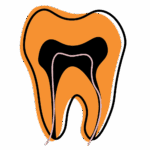 Illustration of a tooth cross-section showing dark decay reaching inner nerves