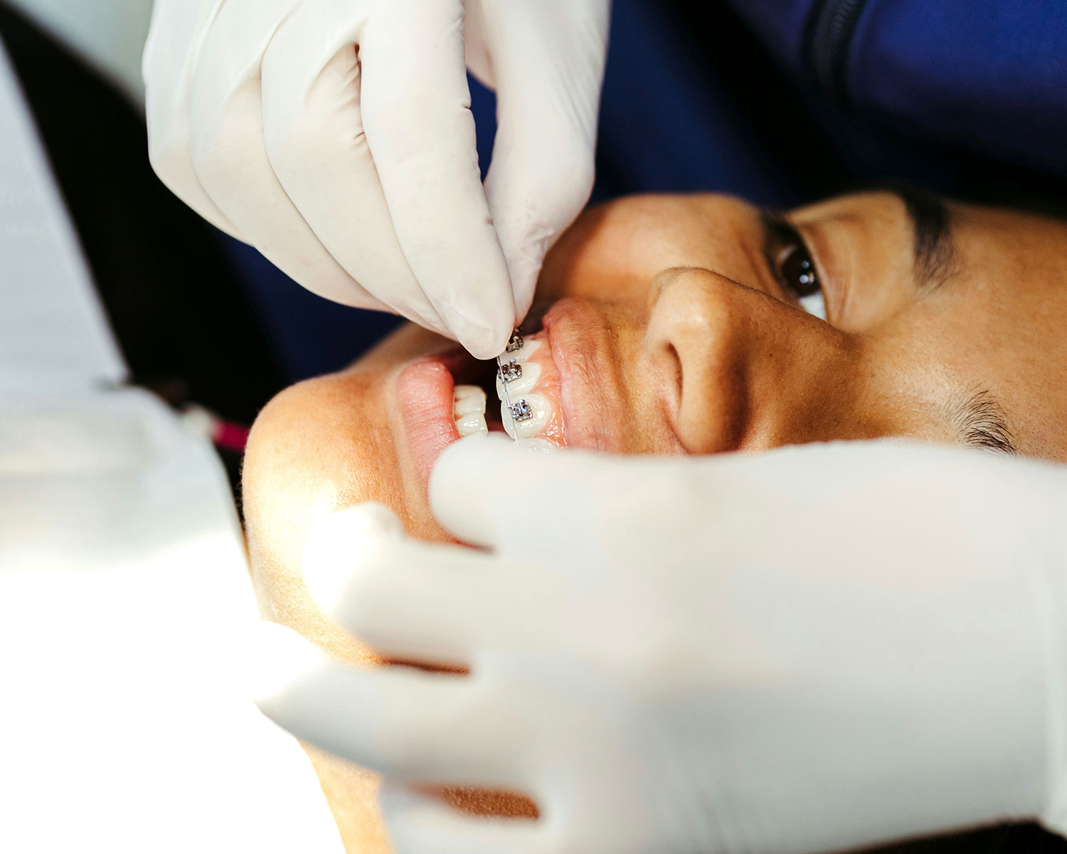 Emergency orthodontist repairing braces for a child during an urgent dental visit