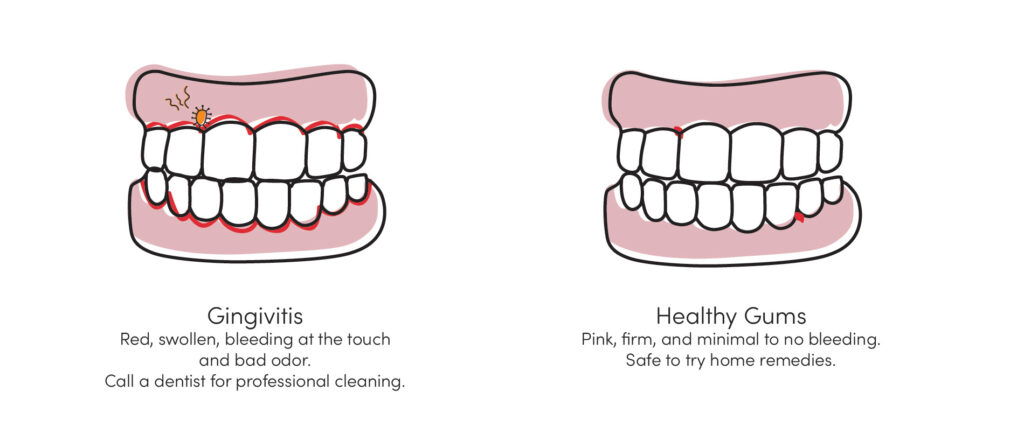 Illustration comparing gingivitis with red, swollen, bleeding gums versus healthy pink gums with minimal bleeding