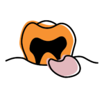 Tooth cross-section with dark infected area, illustrating a dental abscess