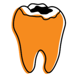 Illustration of a tooth with a lost filling or crown exposing inner tooth structure