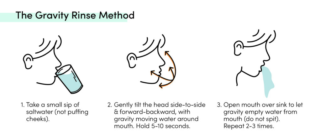 Gravity rinse method for dental aftercare showing gentle saltwater rinse technique without spitting