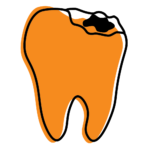 Illustration of a small chipped tooth with minor enamel damage