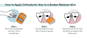 Apply orthodontic wax to a broken retainer wire: roll wax, dry area, and cover the sharp or poking wire end