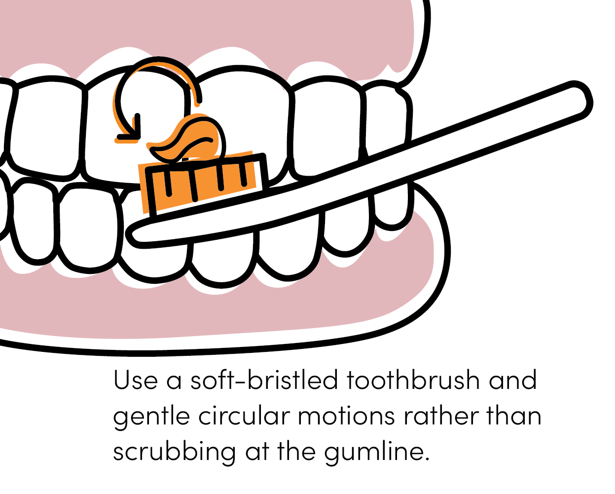 Proper brushing technique using soft toothbrush and gentle circular motions along the gumline