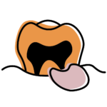 Swollen and tender gums illustration beside infected tooth showing gum inflammation and dental pain