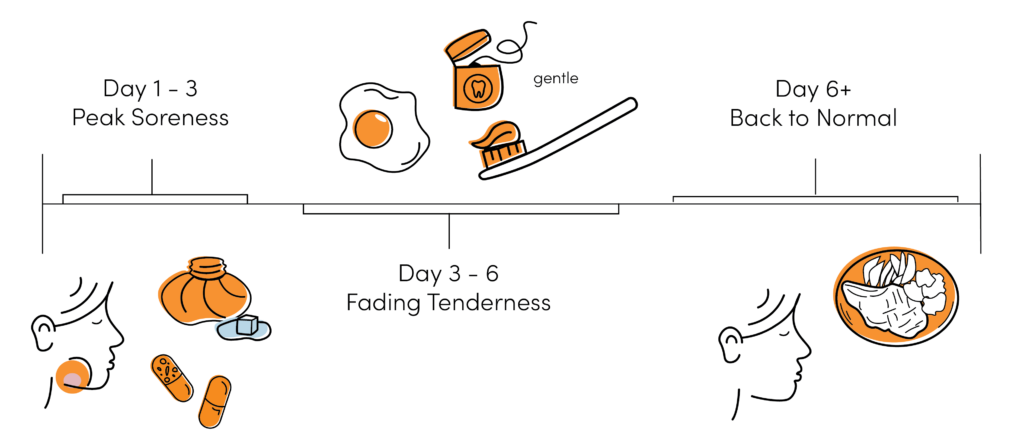 Root canal recovery timeline showing peak soreness, fading tenderness, and return to normal eating