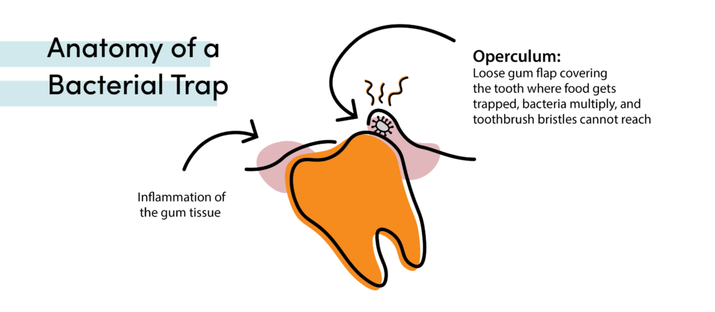 Diagram showing how an operculum traps food and bacteria around a partially erupted wisdom tooth, causing pericoronitis