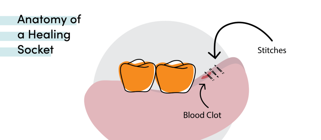Healing tooth extraction socket diagram showing blood clot, stitches, and normal healing after tooth removal