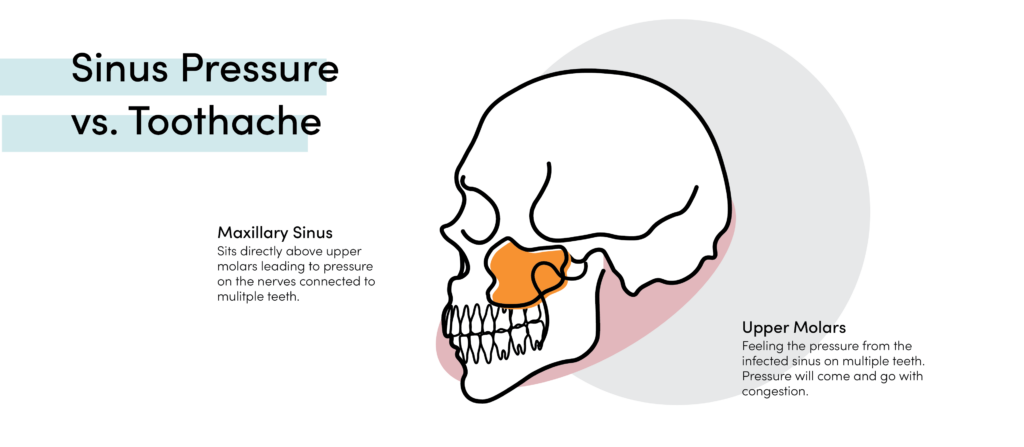 Skull diagram showing maxillary sinus above upper molars, explaining sinus pressure-related tooth pain