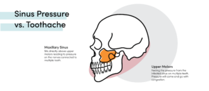 Skull diagram showing maxillary sinus above upper molars, explaining sinus pressure-related tooth pain