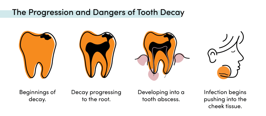 Diagram showing tooth decay progression from cavity to root infection to facial abscess and cheek swelling