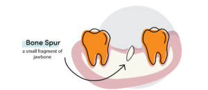 Diagram of a dental bone spur showing a small, sharp jawbone fragment surfacing through the gum after a tooth extraction