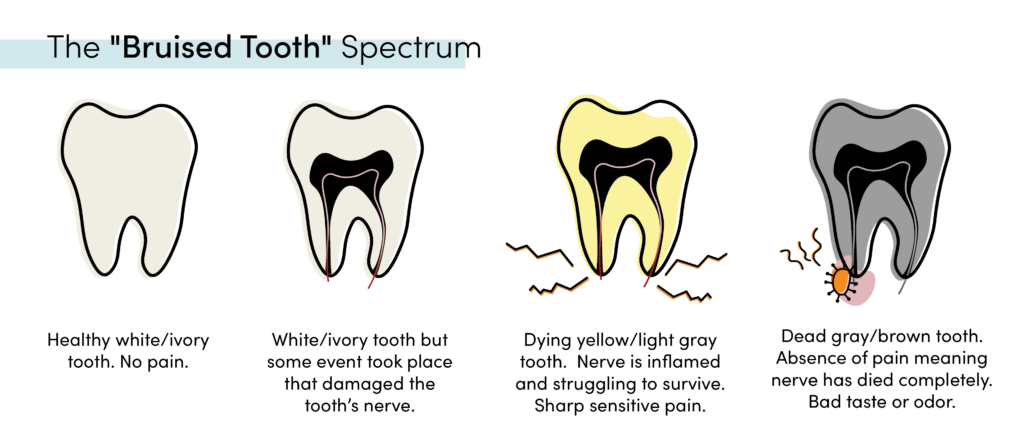 Diagram of the bruised tooth spectrum, from a healthy white tooth to a dead gray-brown tooth with an inflamed or dying nerve