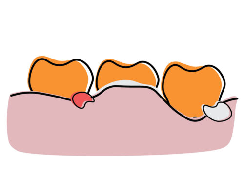Illustration of three teeth with swollen pink gums showing red and white abscesses, symbolizing gum infection