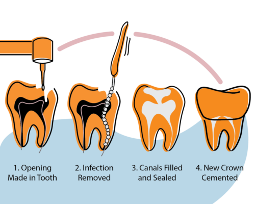 Root canal procedure steps illustration showing infection removal, canal filling, and crown placement