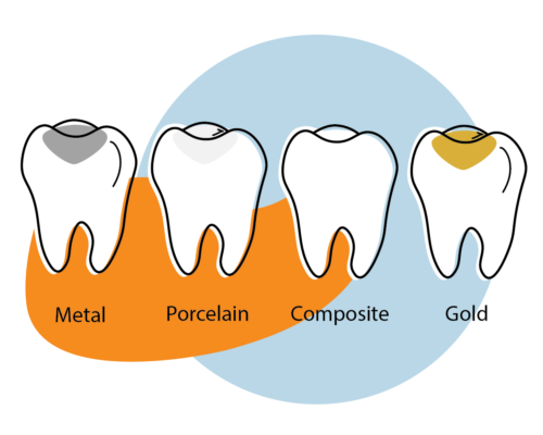 Dental restoration materials illustration comparing metal, porcelain, composite, and gold tooth repair options