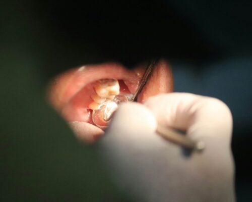 Dentist in gloves uses tools to examine patient’s back teeth